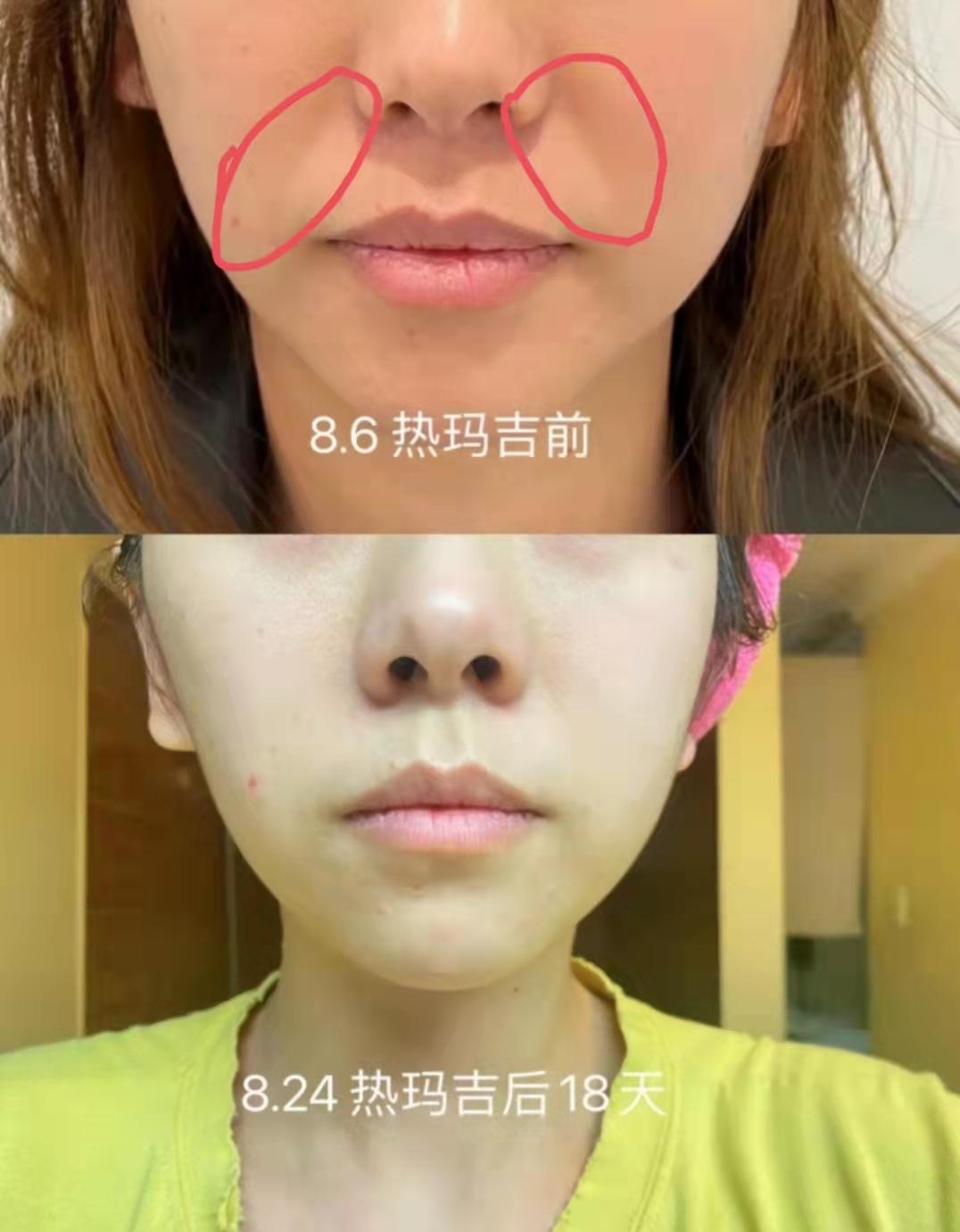 拒绝垮脸！法令纹怎么改善最有效？过来人手把手教你去法令纹