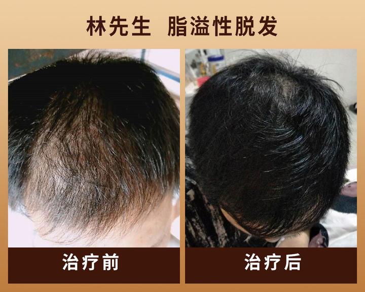 生发不困难,长出浓密头发,全靠这项新技术 - 知乎