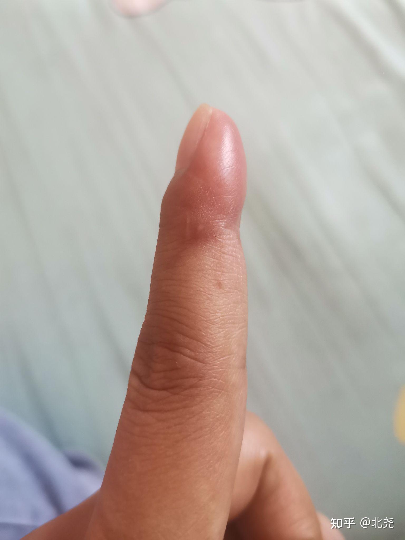 手指肌腱神经断裂需要多久恢复?术后9天手指还肿正常吗? - 知乎