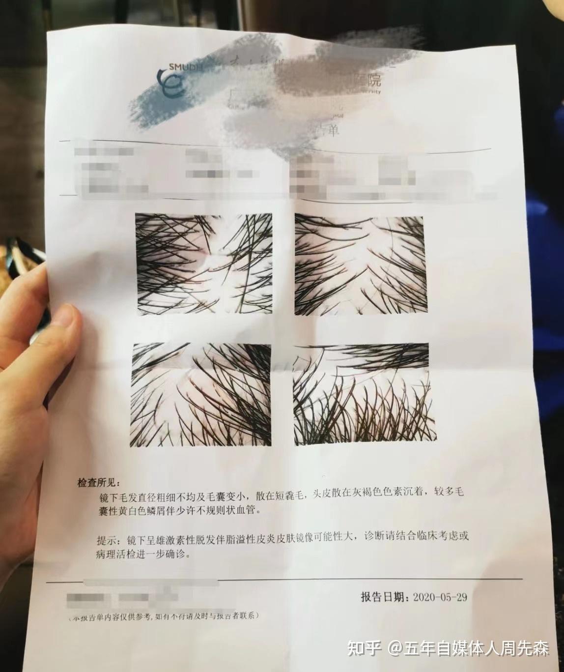 发旋处头发太少了!,我是不是要秃了,怎么办啊! - 知乎