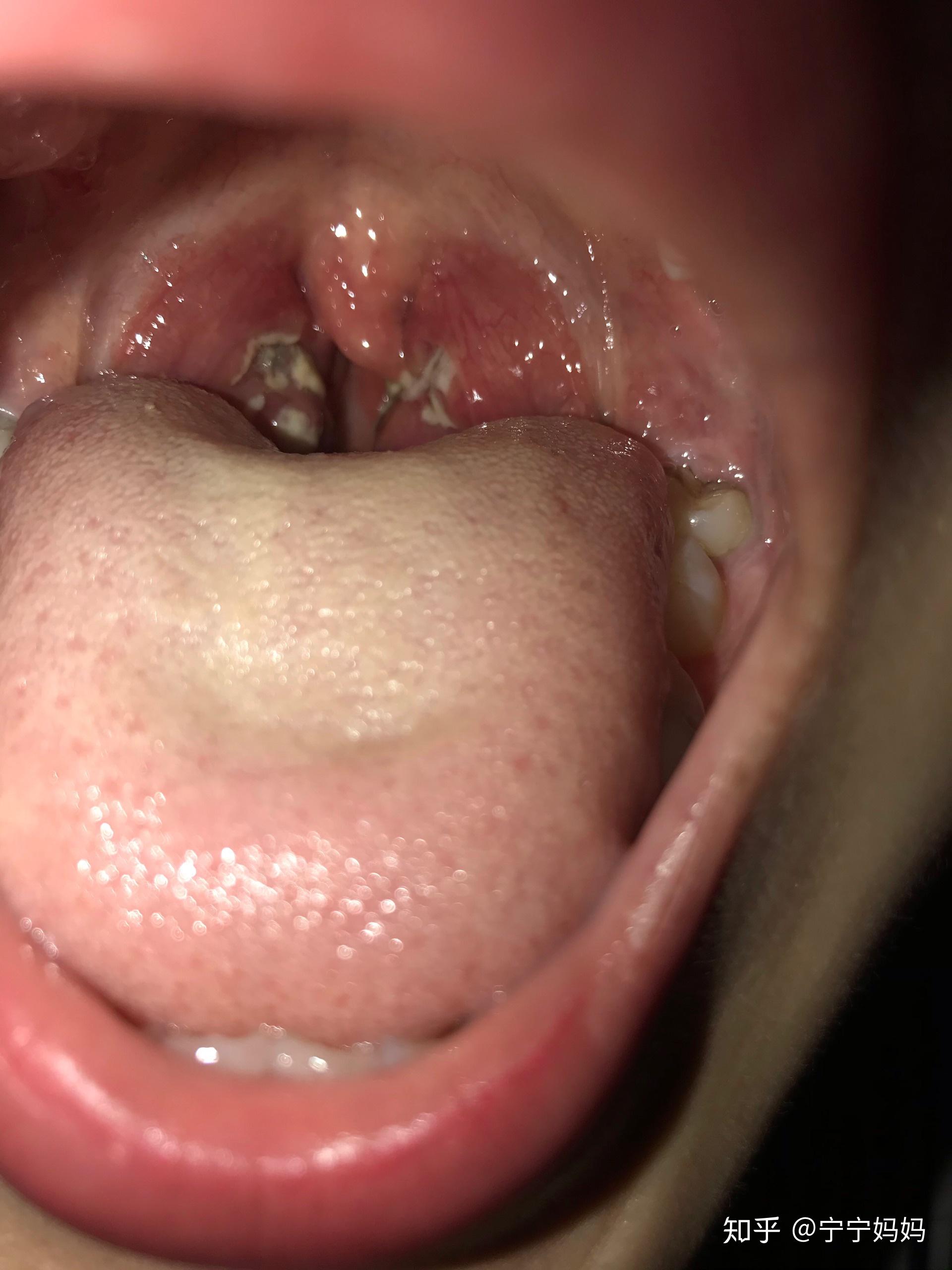 患急性扁桃体炎是怎样一种经历和感受? - 知乎