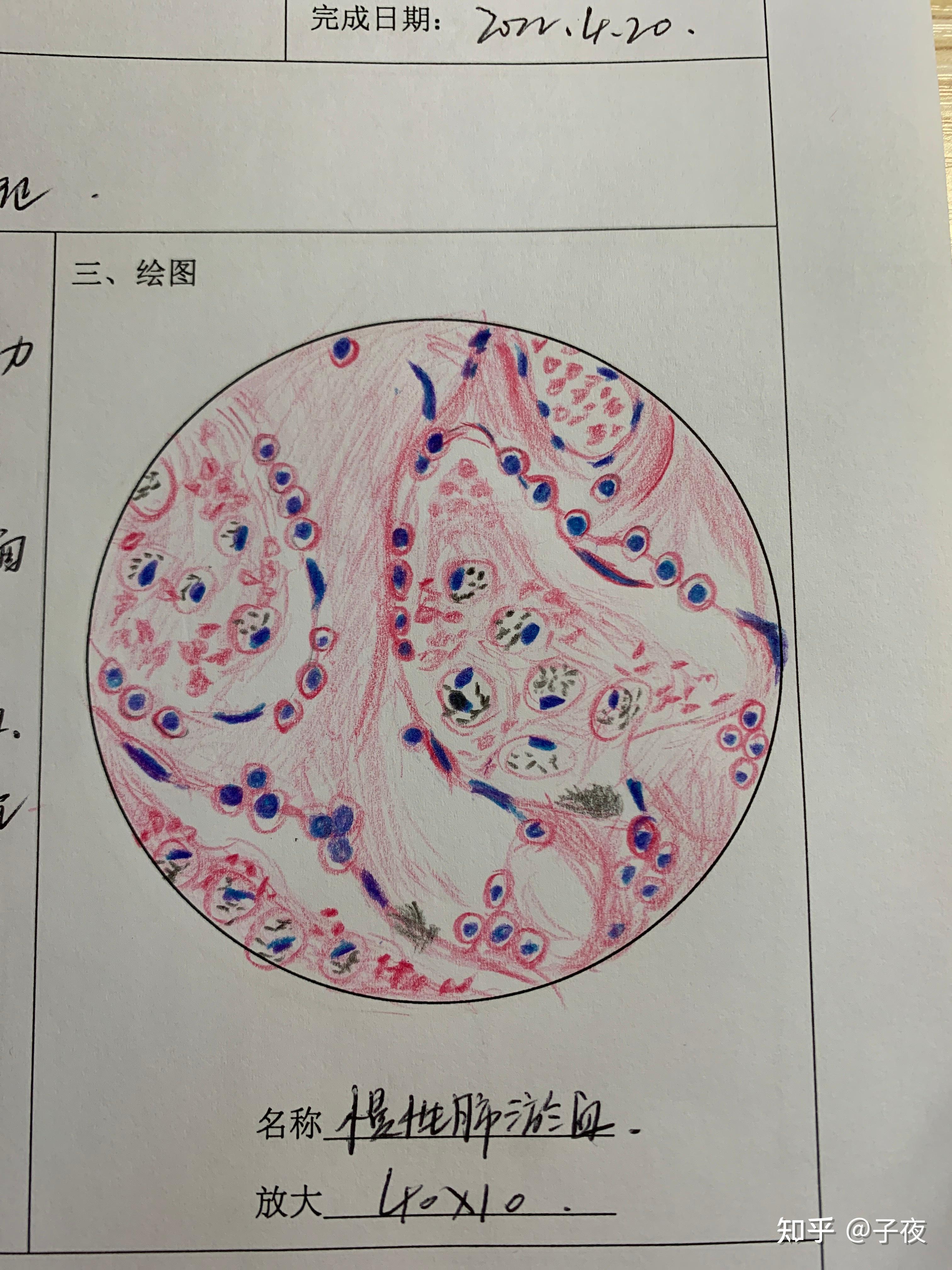 肺淤血切片手绘图图片