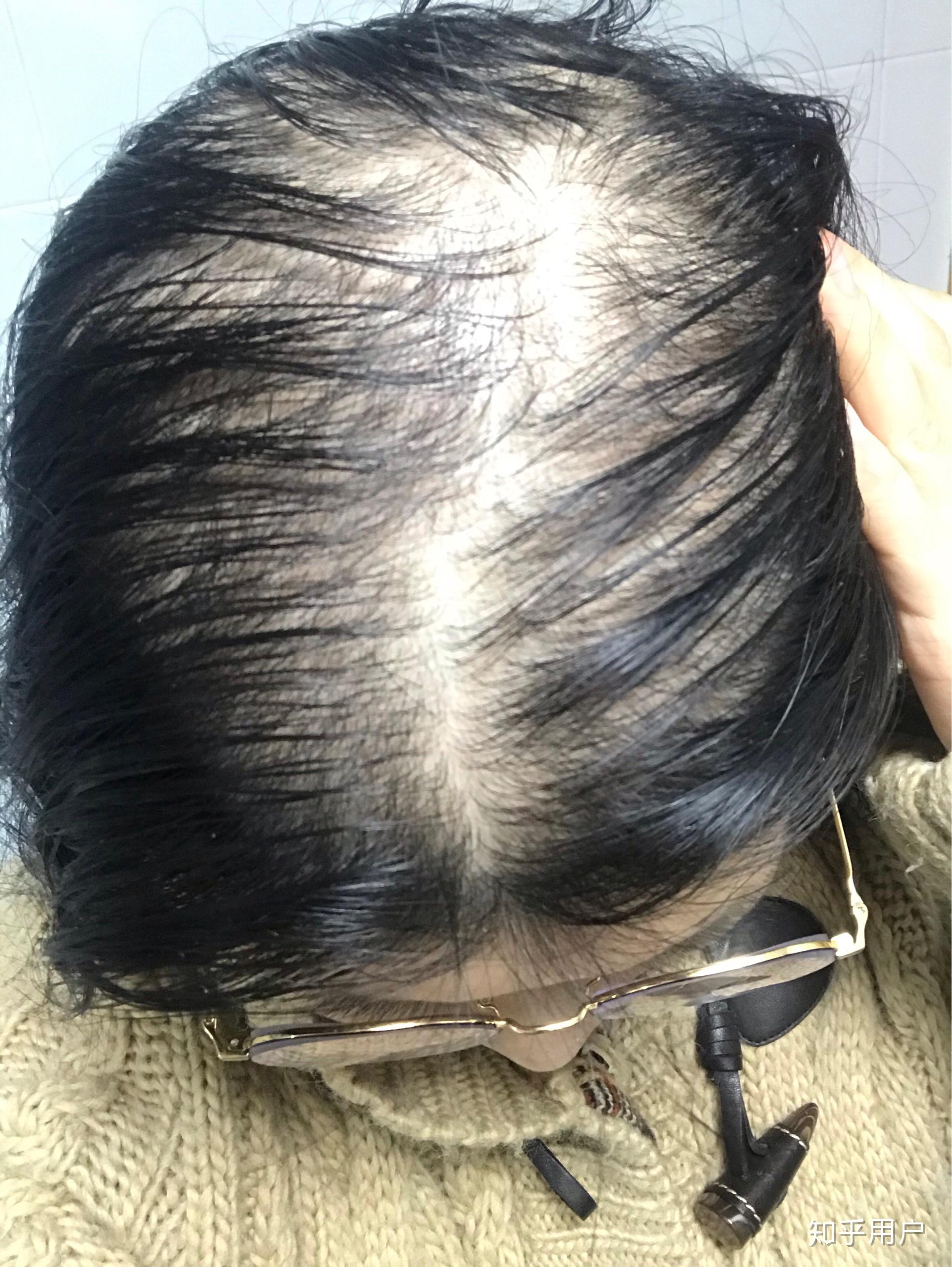 女生秃顶是怎样一种体验? - 知乎