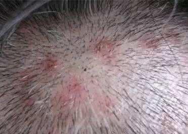 带你认识毛囊炎脂溢性皮炎