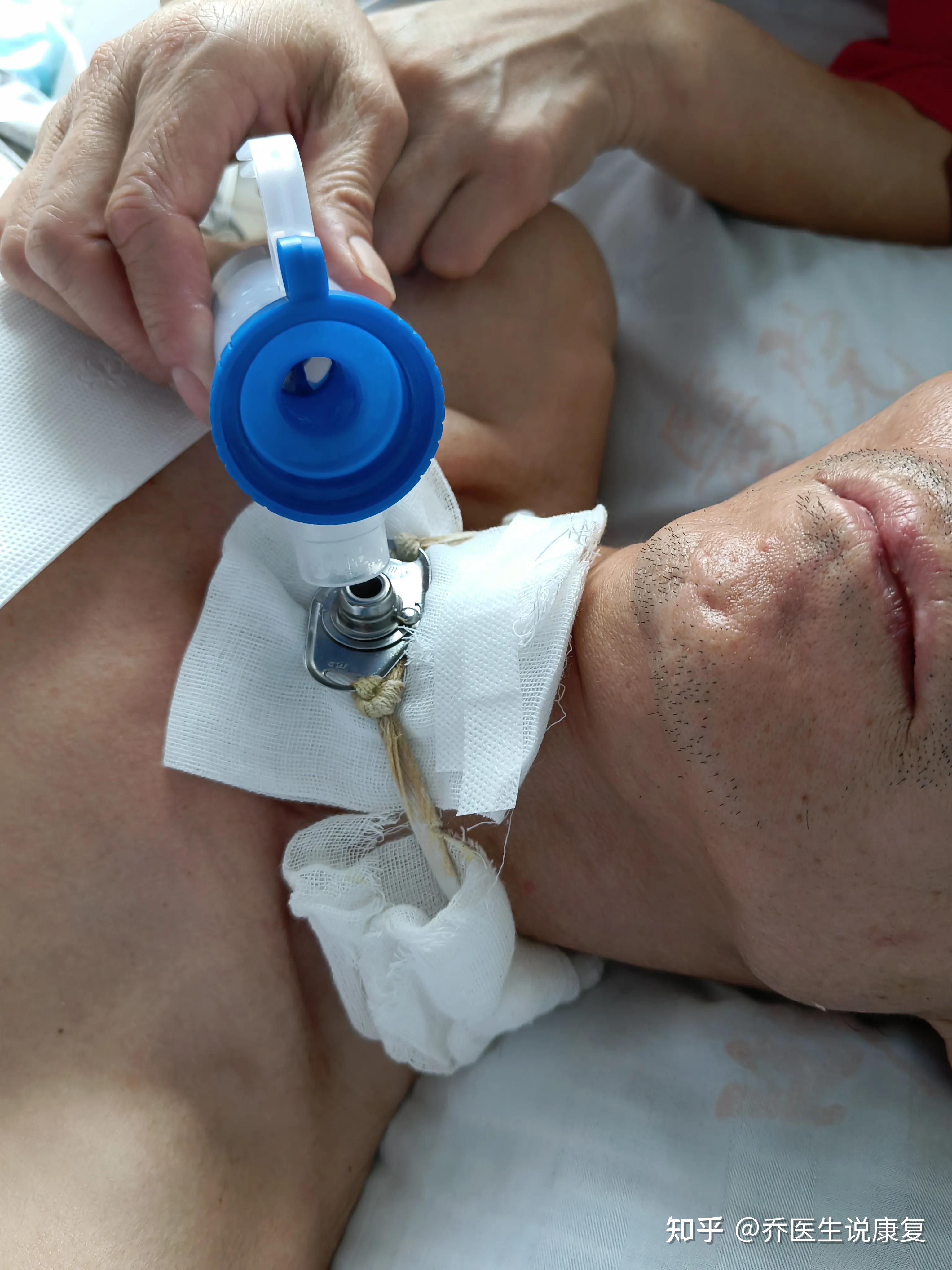 为什么脑外科很多气管切开的患者?