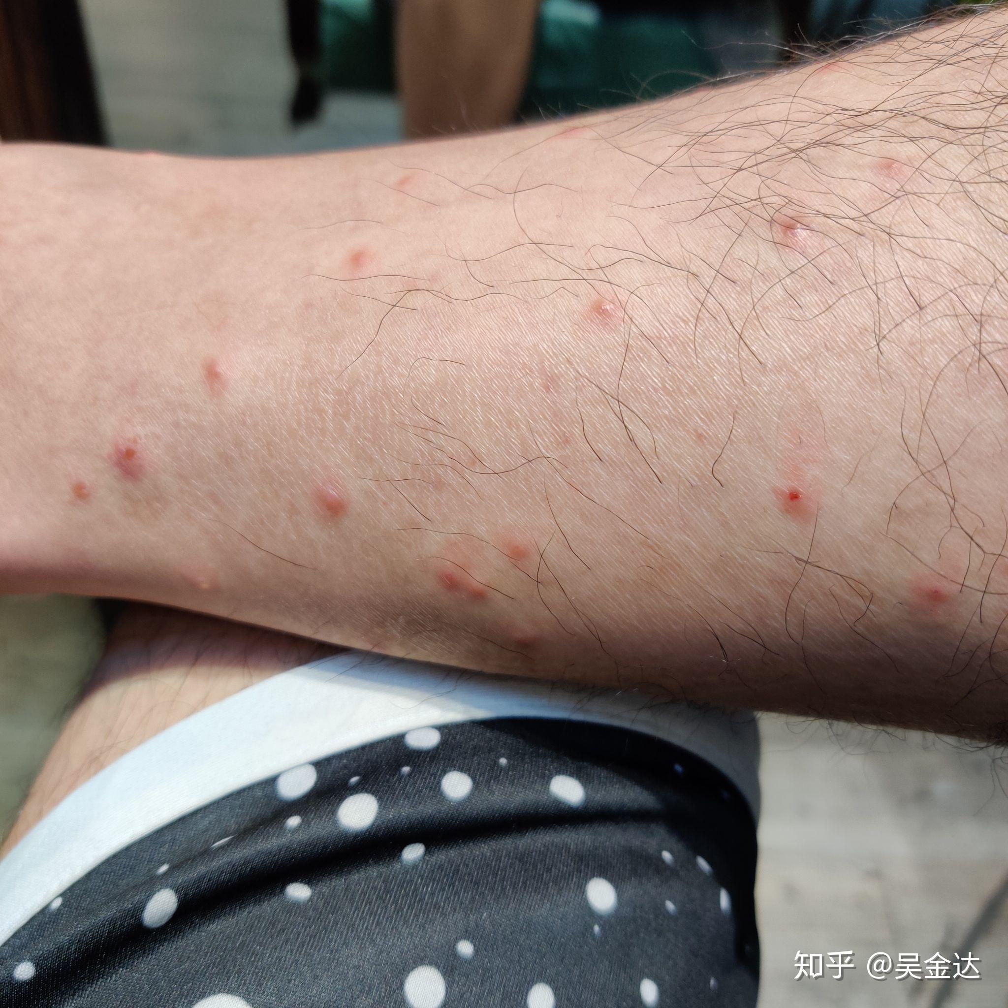 如何防止被黑蠓叮咬及叮后处理方法? - 知乎
