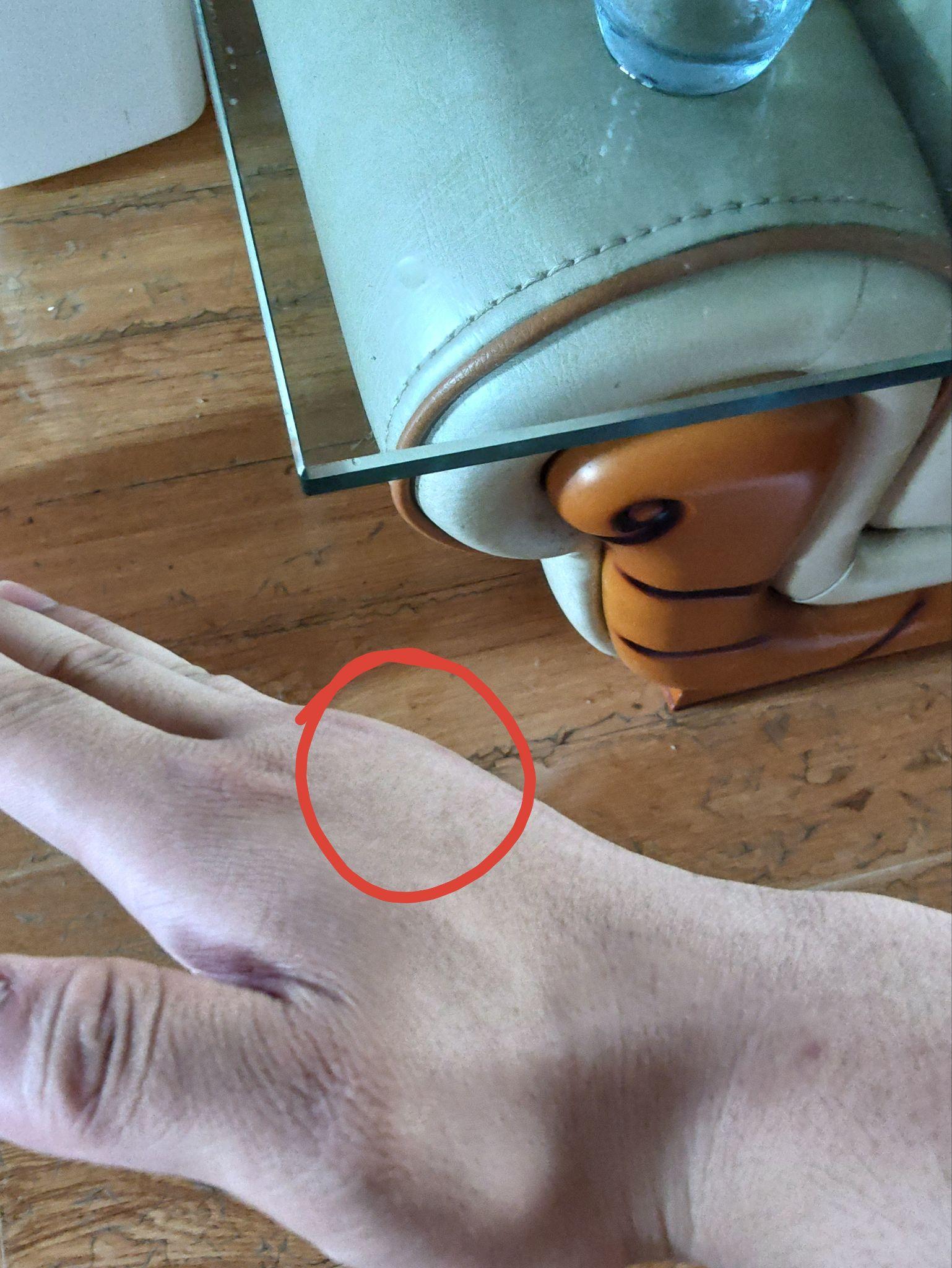 洋辣子有毒吗?被蜇后怎么处理?