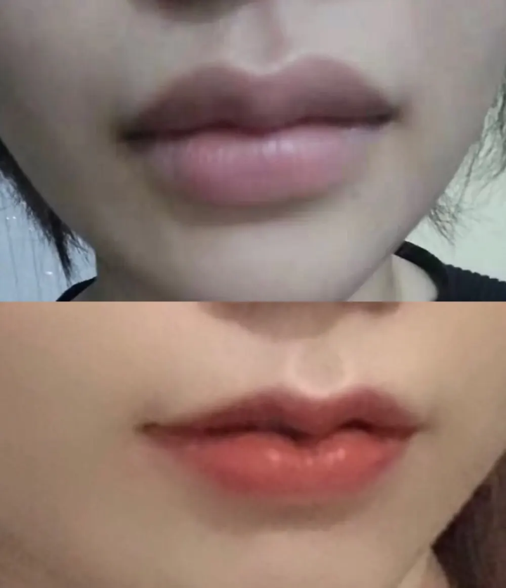 厚嘴唇变薄手术的方法有哪些厚唇改薄手术恢复时间需要多久