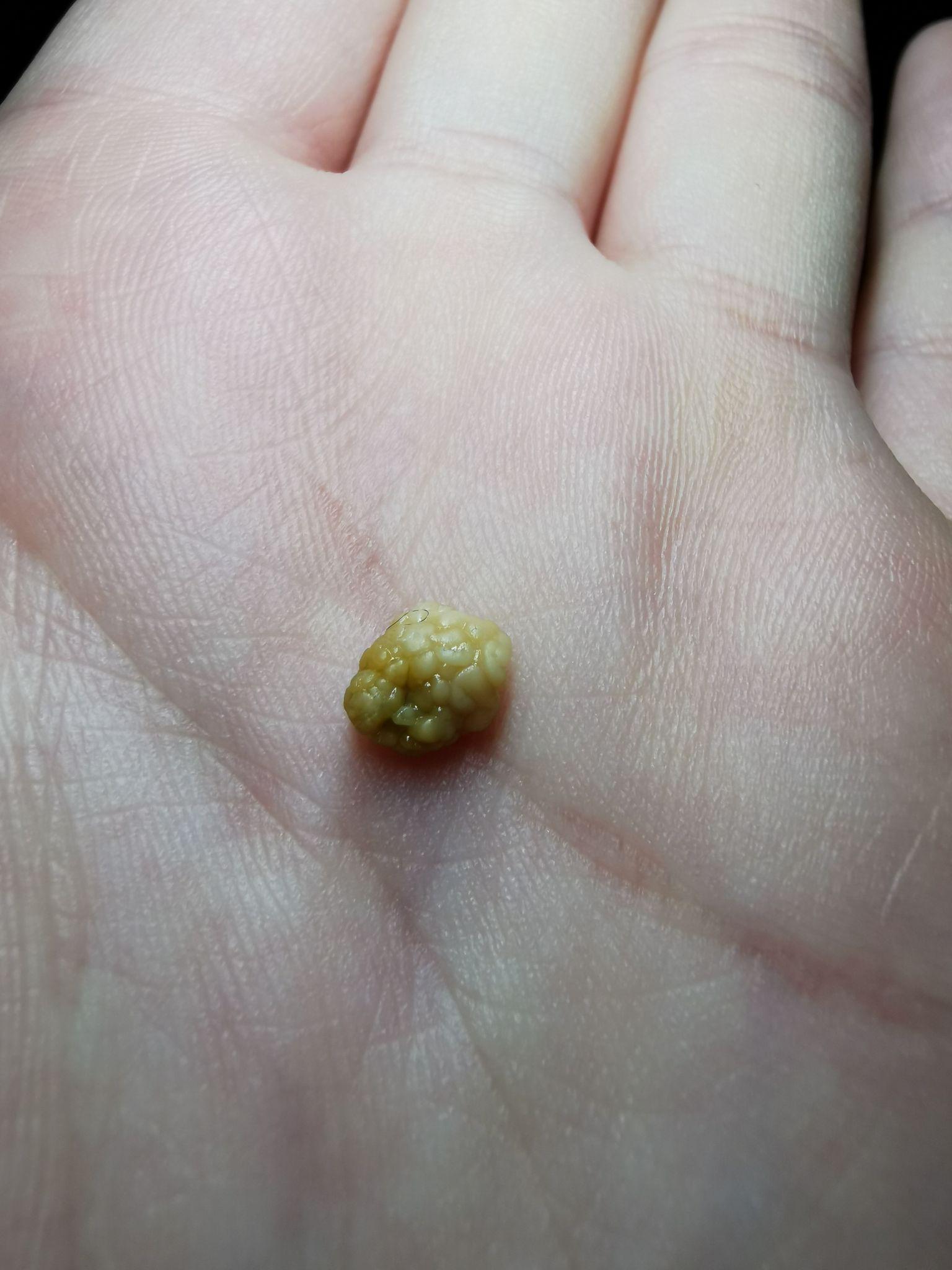 你见过最大的扁桃体结石有多大