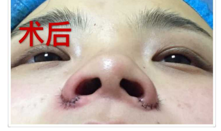 鼻翼缩小手术是不是失败了