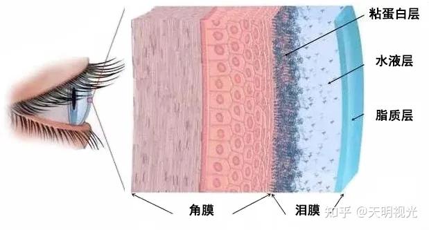 隐形眼镜会磨损角膜吗?