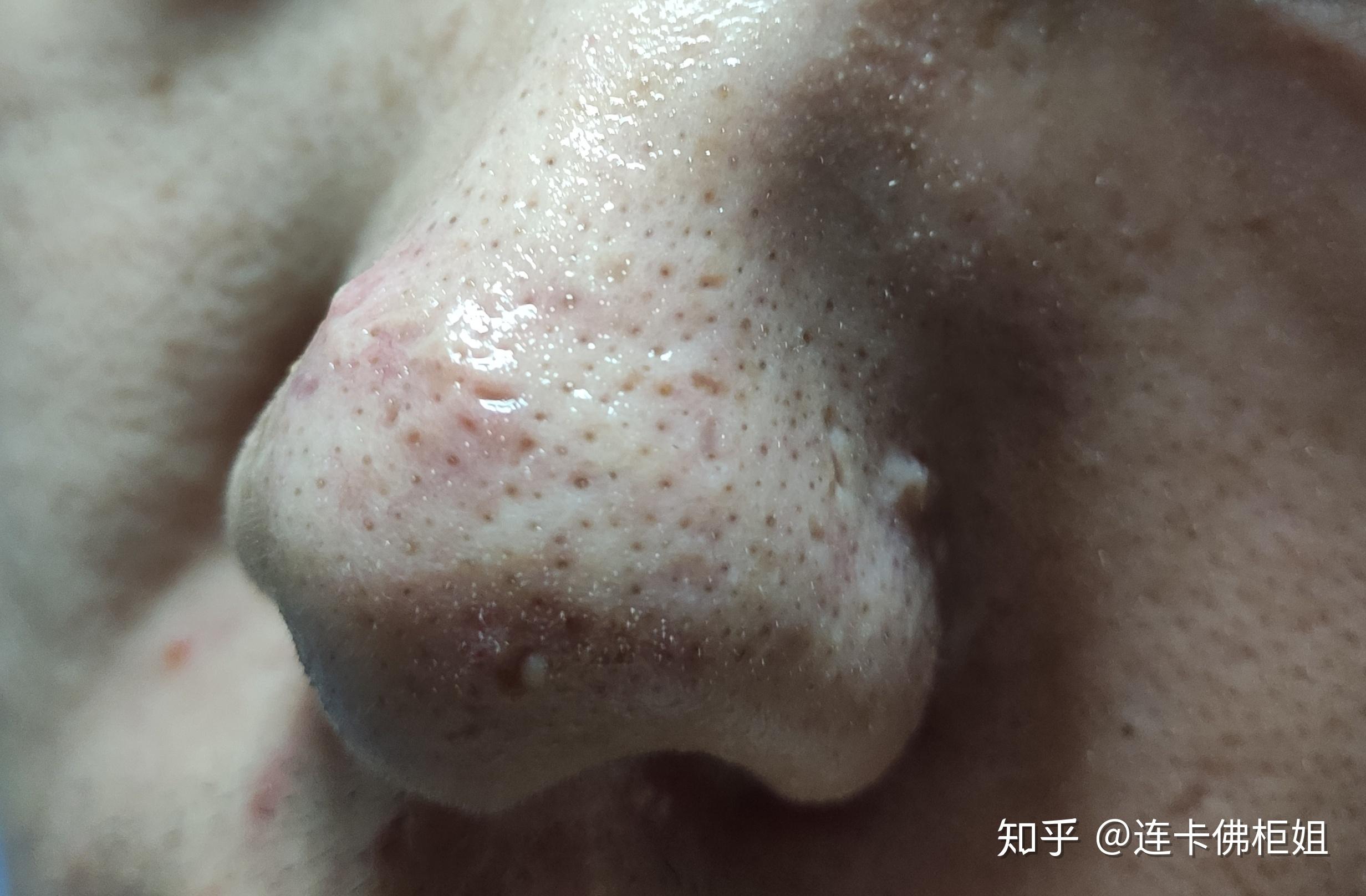 这算是草莓鼻吗?