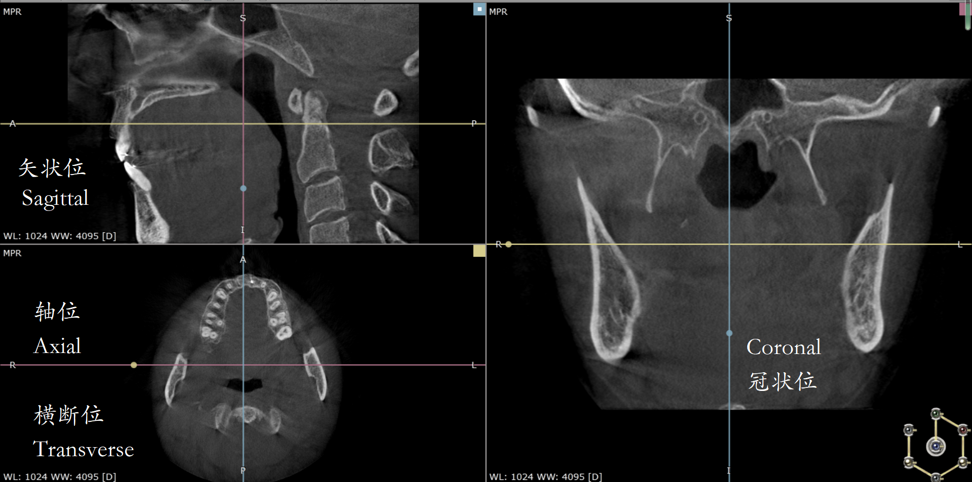 冠状位+矢状位+轴位图图片