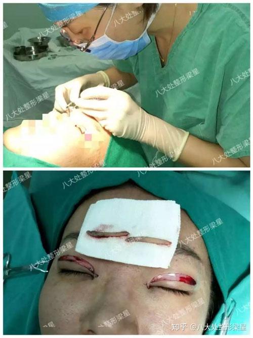 有没有做双眼皮手术过程中被吓哭的