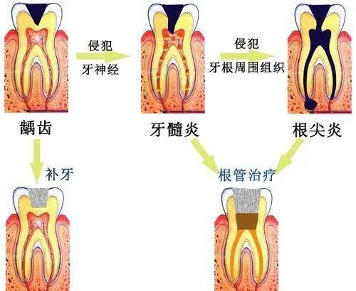 牙髓炎？根尖炎？傻傻分不清楚 - 知乎