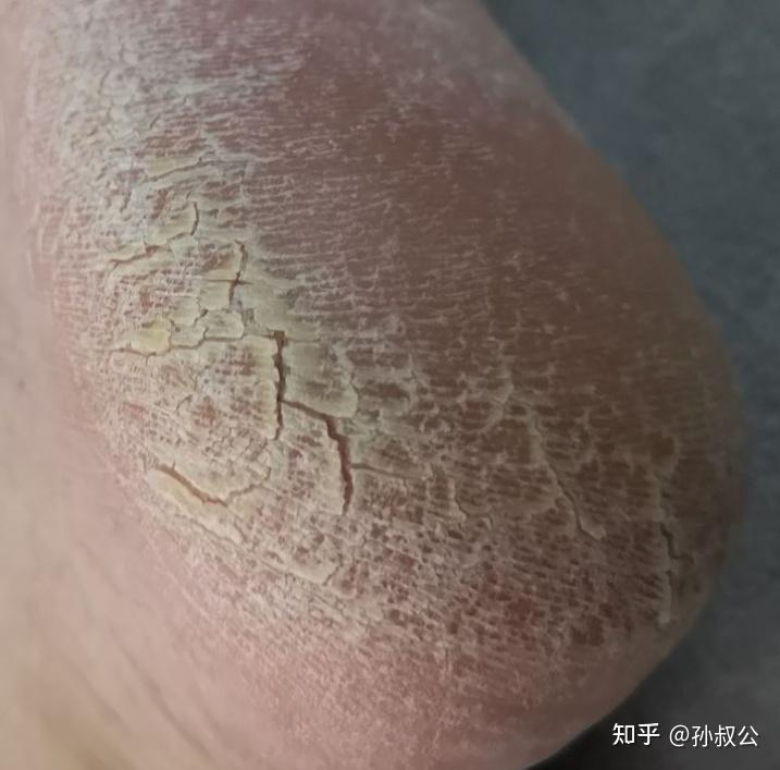 怎样才能摆脱脚上的真菌感染