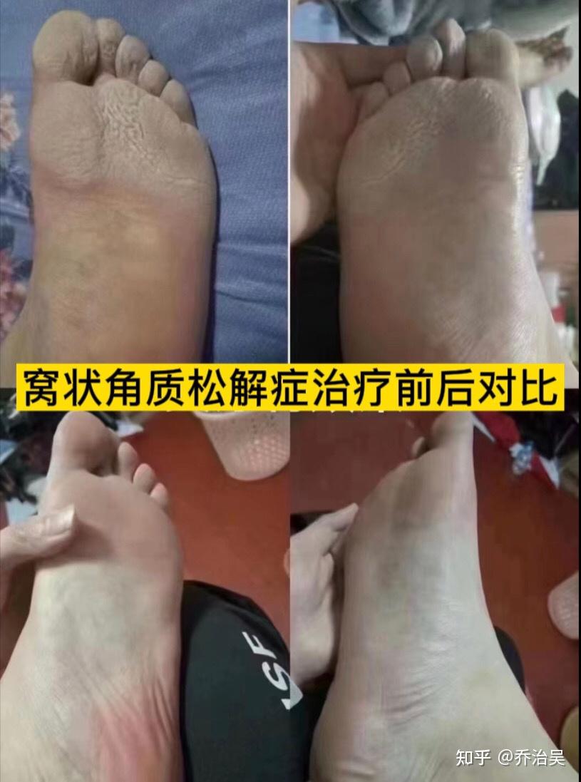 脚气和脚臭的区别是什么