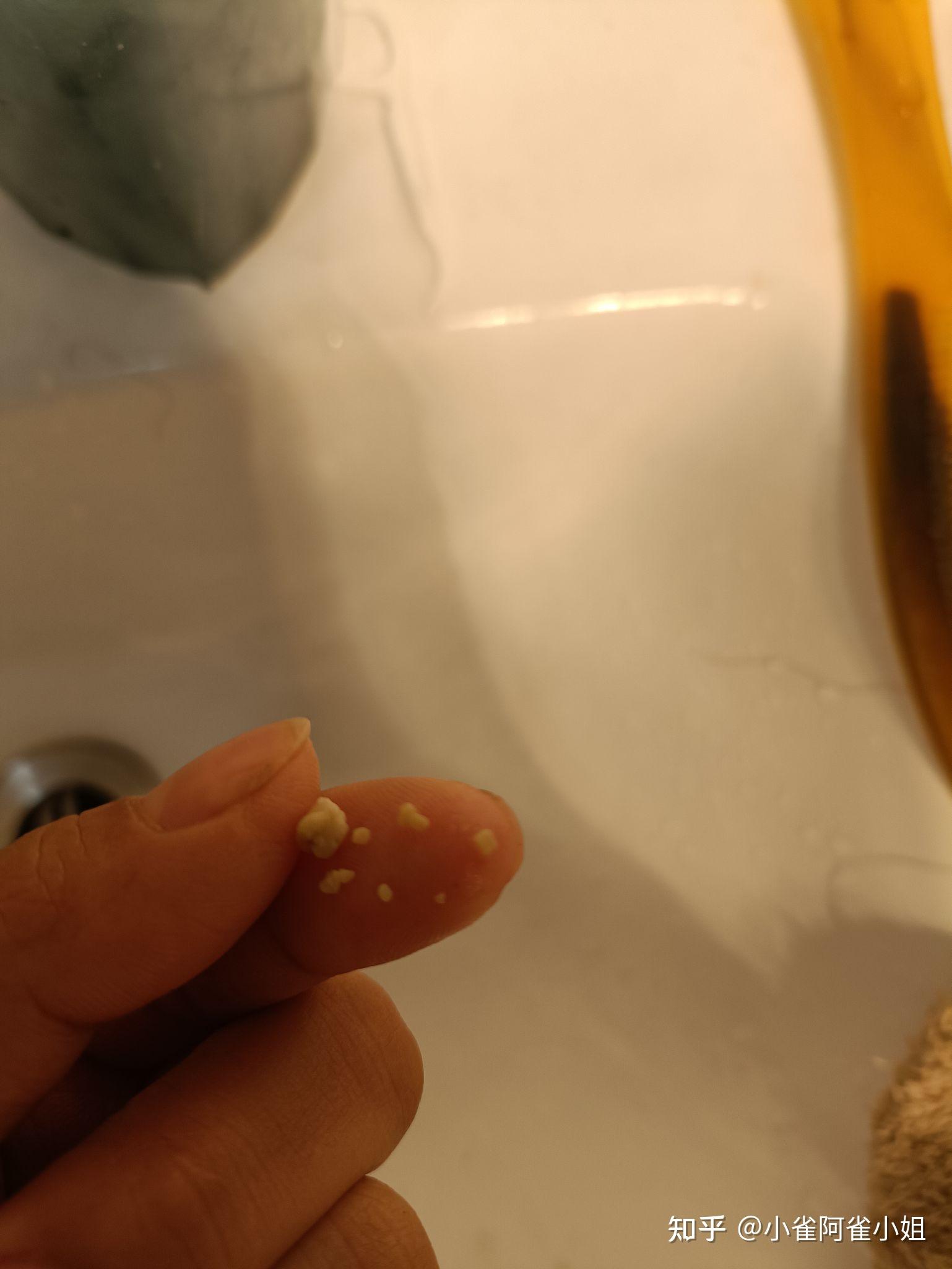 扁桃体结石能大到什么程度