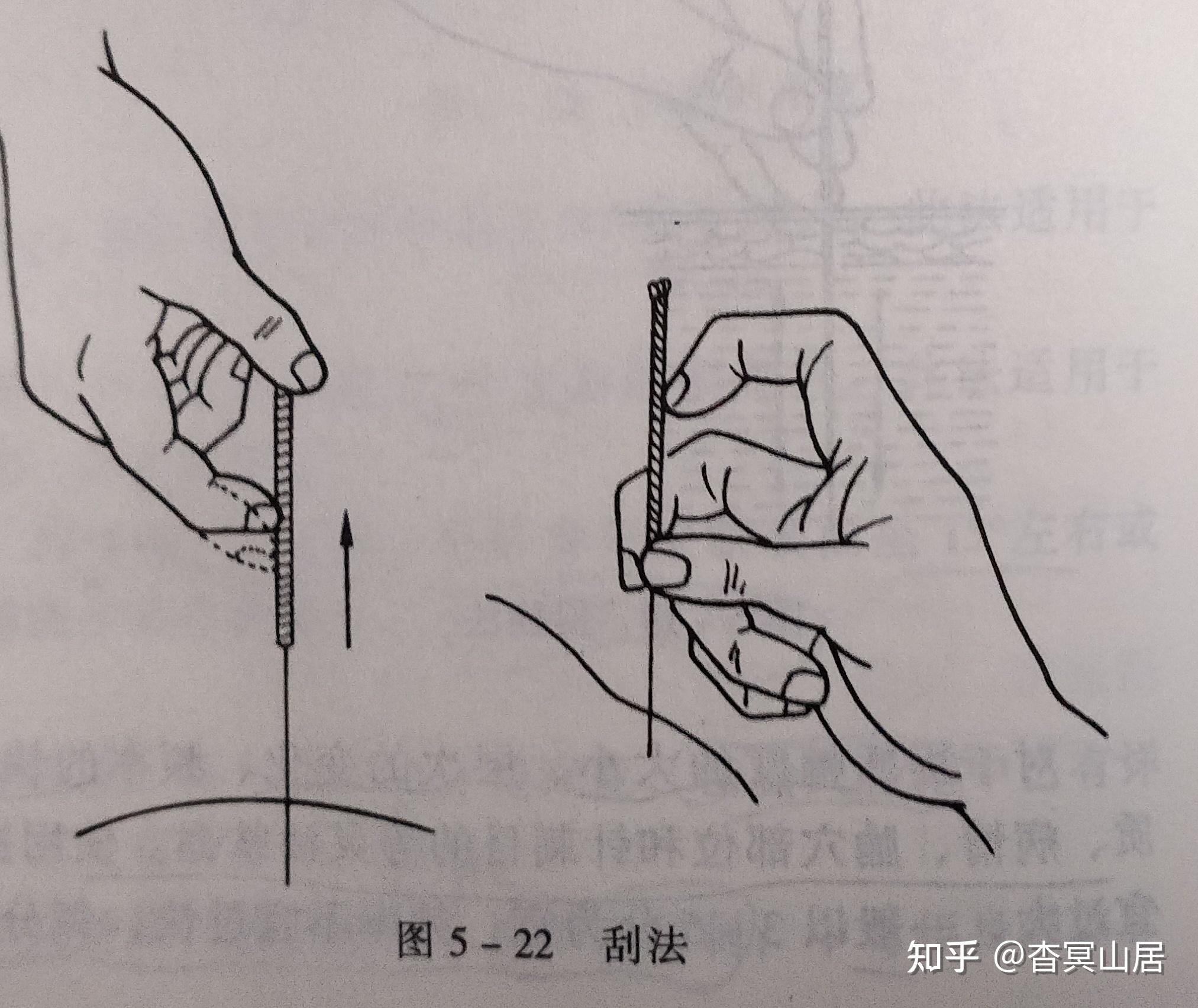 笔记摘要——针灸技术:毫针刺法、补泻原则与灸法概要 - 知乎