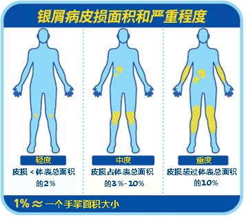 银屑病小贴士一之BSA、PASI和PGA评分详解 - 知乎