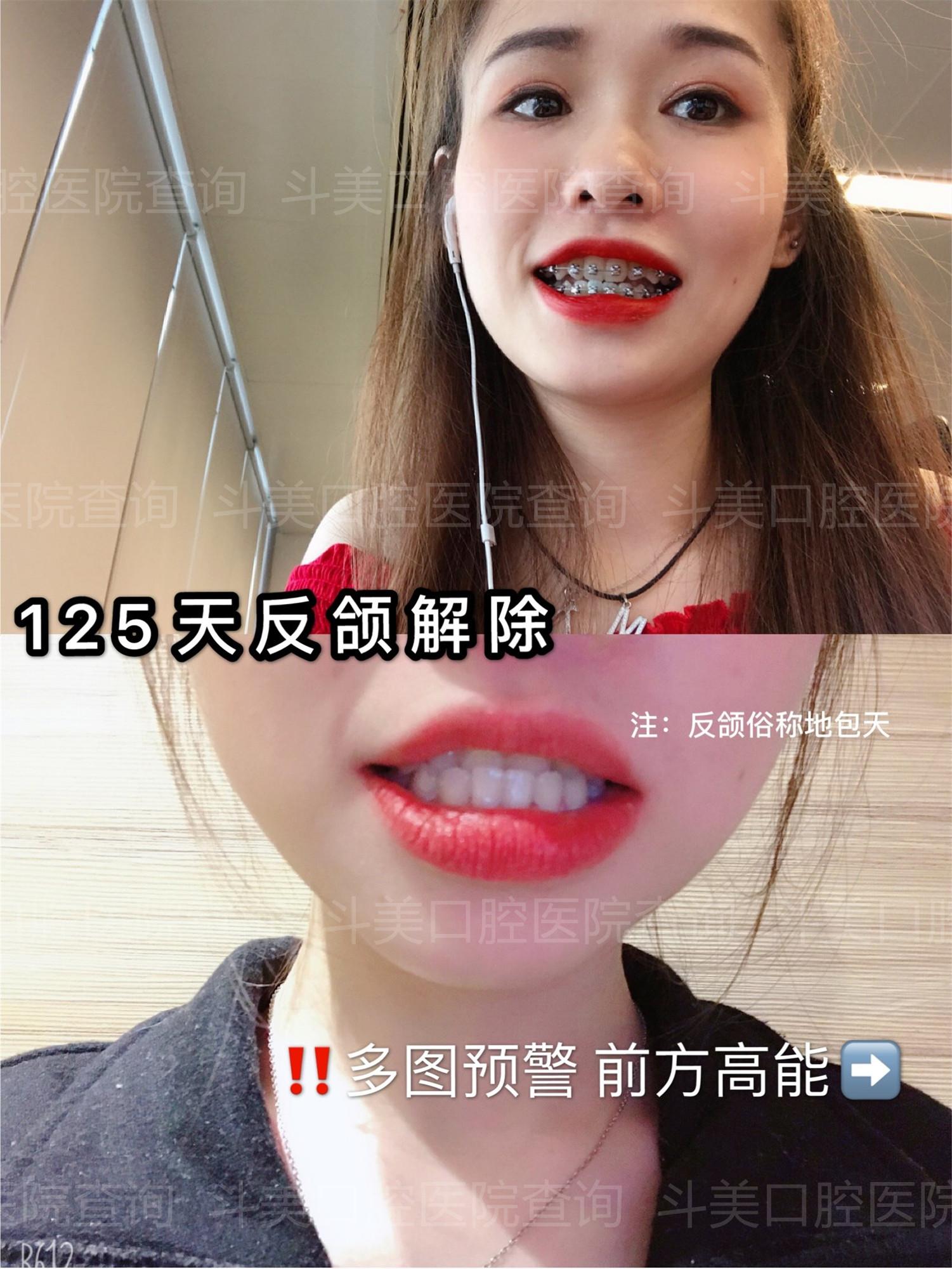 有没有集美们在郑州做过地包天正畸可不可以推荐一下