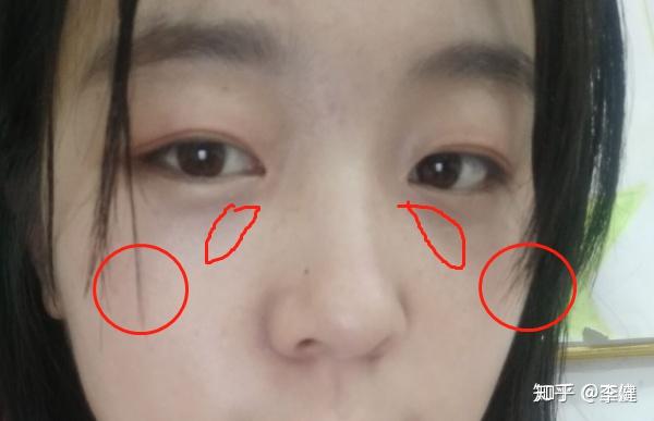 请问我是应该填苹果肌还是泪沟?