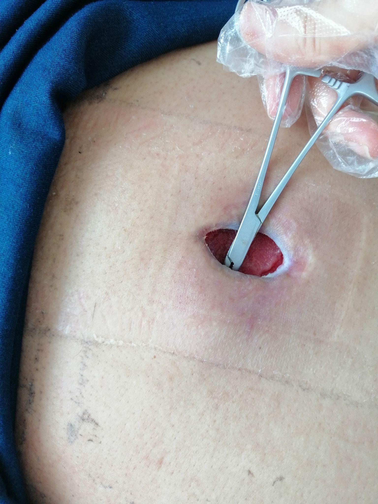 人体的火疖子 (化脓性毛囊及毛囊深部周围组织的感染) 能有多大?