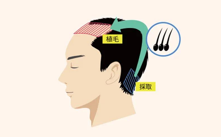 植发几年后的效果还会和刚植发的效果一样吗? - 知乎
