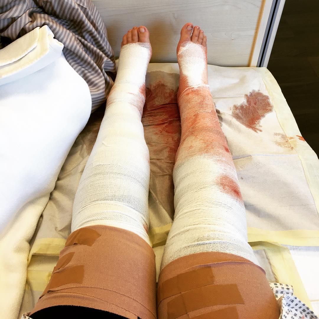 有朋友做过腿部吸脂手术吗,谈谈你的真实经历? - 知乎