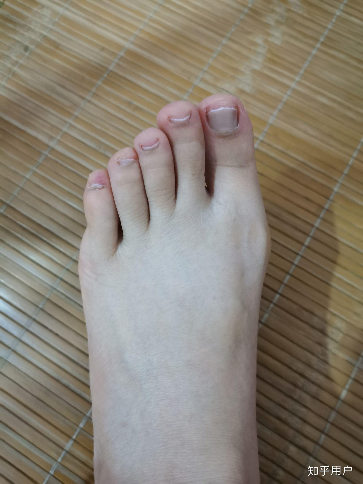 小脚趾的指甲特别难看怎么办