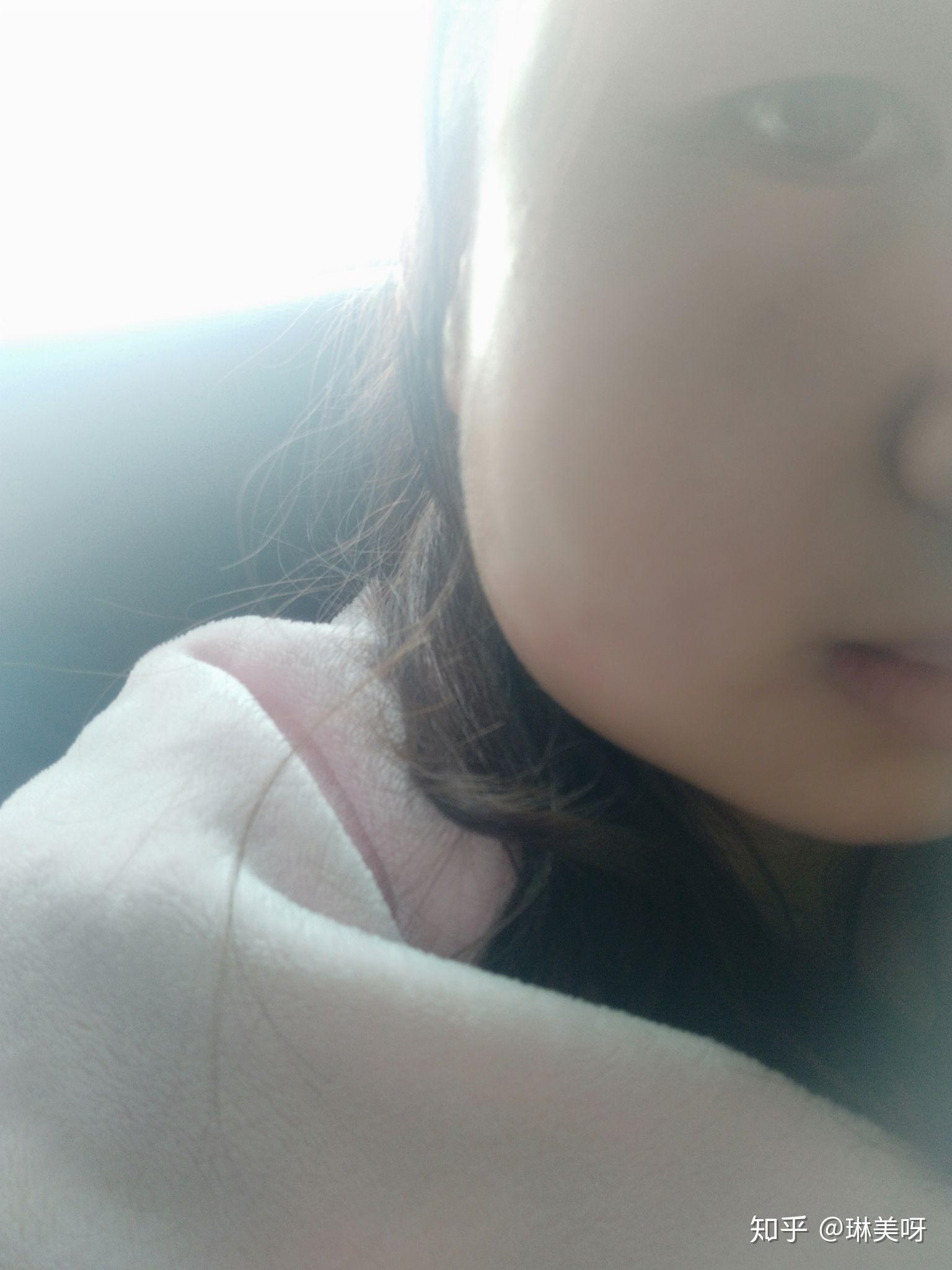 拔牙脸肿一般几天消退