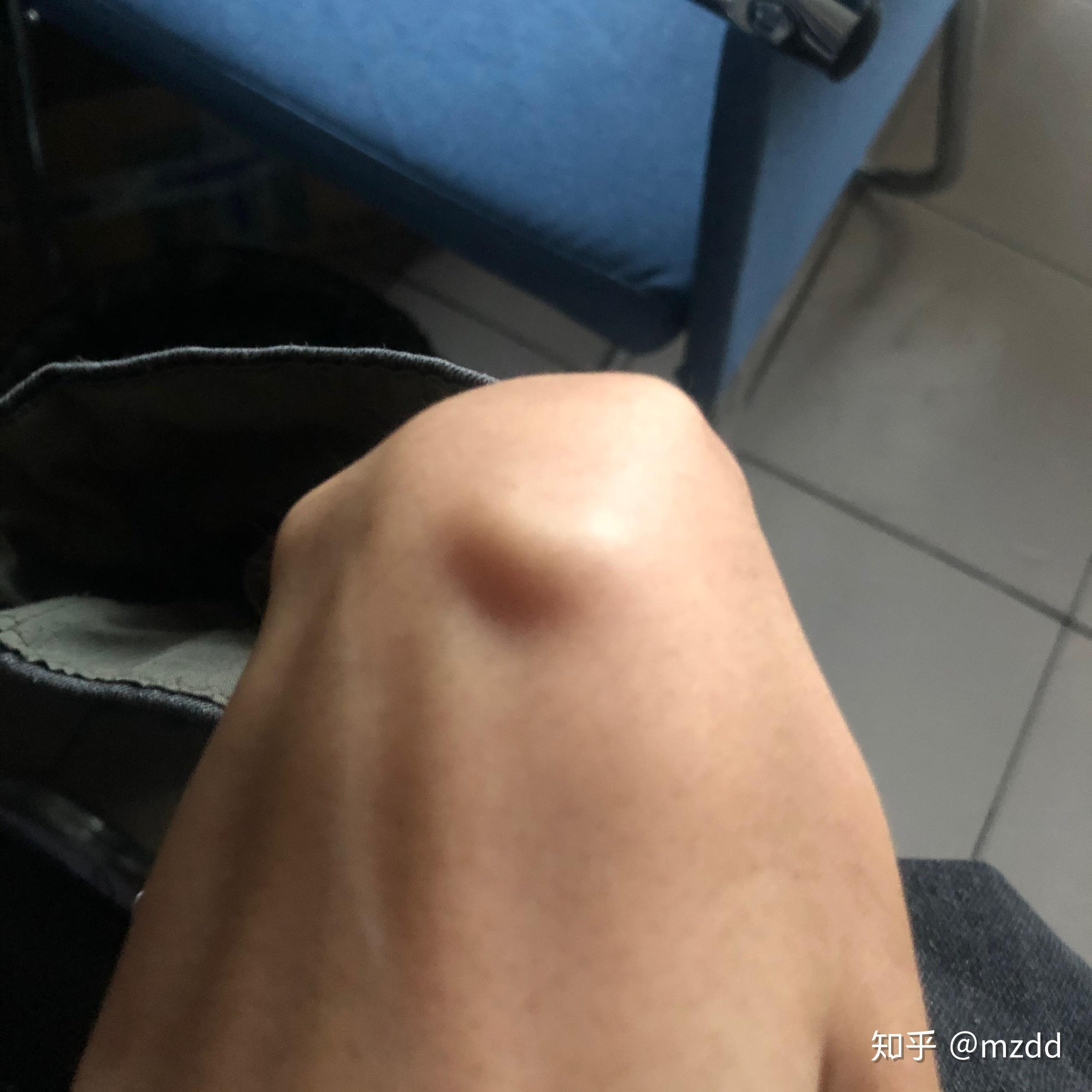 手背腱鞘囊肿能否自愈?