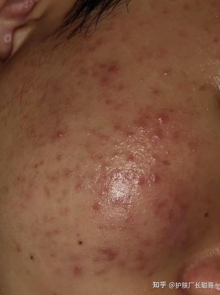 修复油敏肌的护肤要诀,油性敏感皮肤的护理水乳推荐 - 知乎