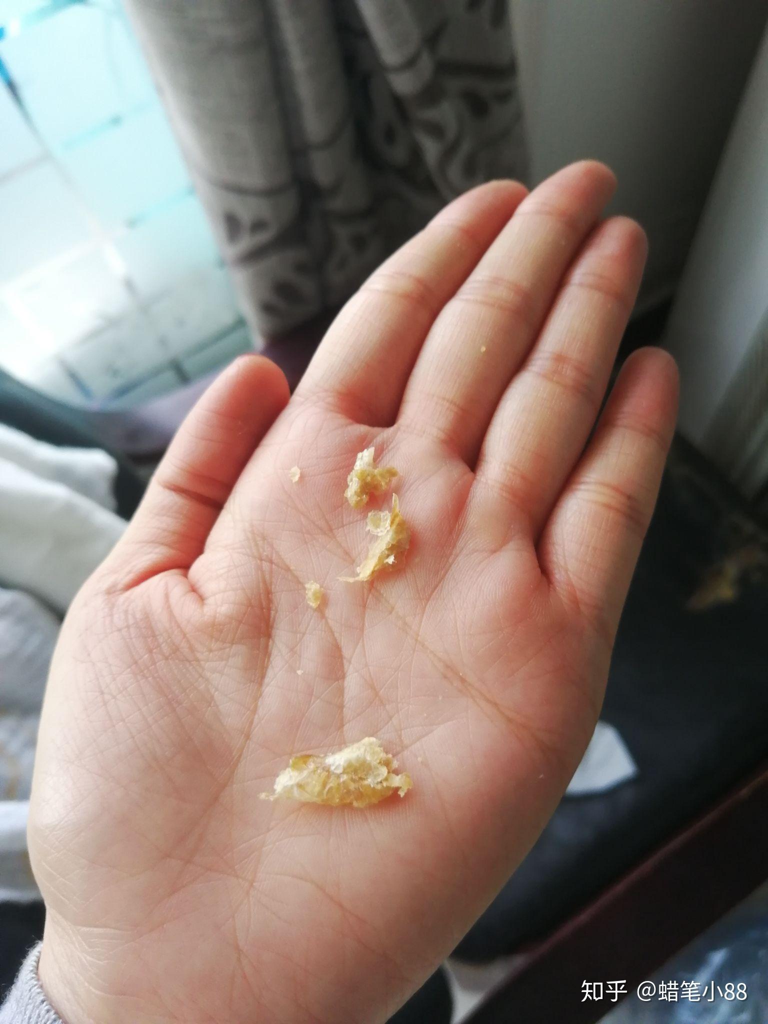 耳屎最大能有多大