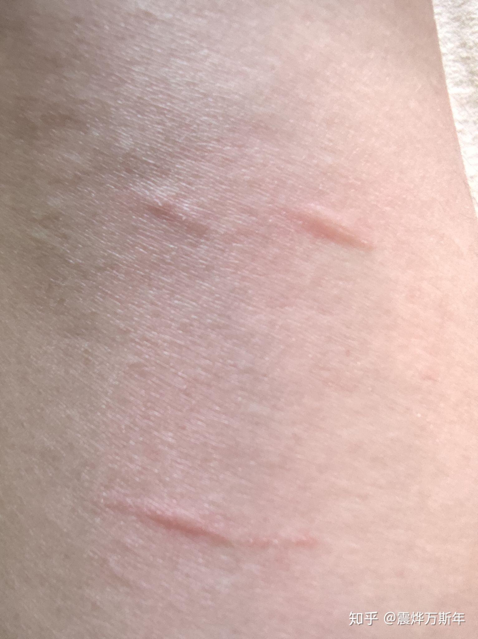 被猫抓了没出血破了一丁点一丁点的皮猜问需要打疫苗吗