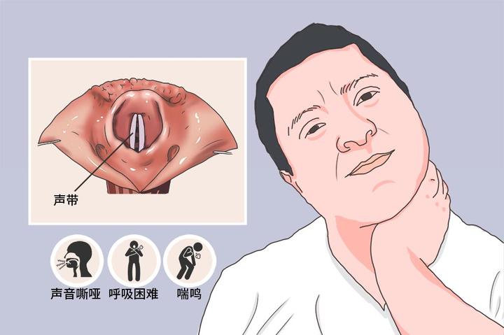 什么是声带麻痹？ - 知乎