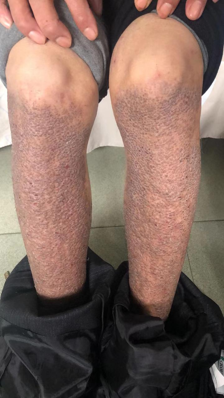 什么是皮肤淀粉样变皮肤淀粉样变有哪些危害该如何正确面对