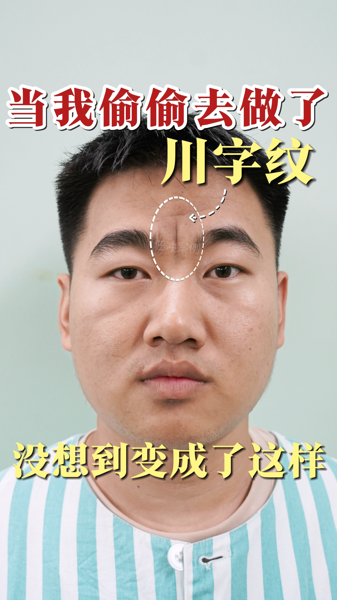 担心留疤的内蒙小伙,川字纹切除6个月真实情况分享!