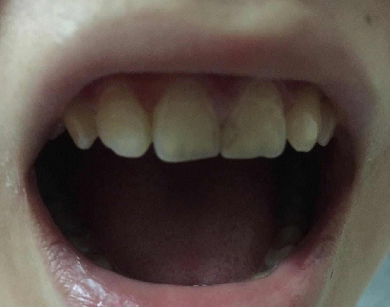 案例分享 | 矫正前内倾型深覆合，牙列拥挤有虎牙，咬合不当，颞下颌关节紊乱，下巴后缩，牙弓真的非常方 - 知乎