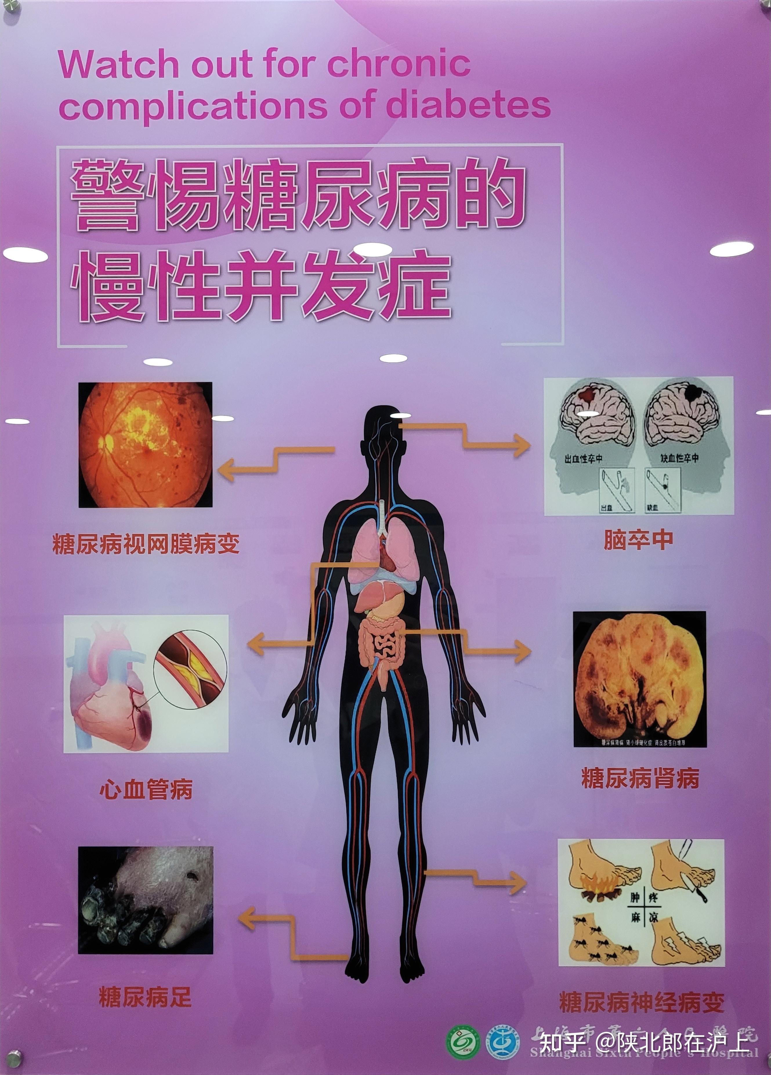 糖尿病并发症为什么这么可怕?