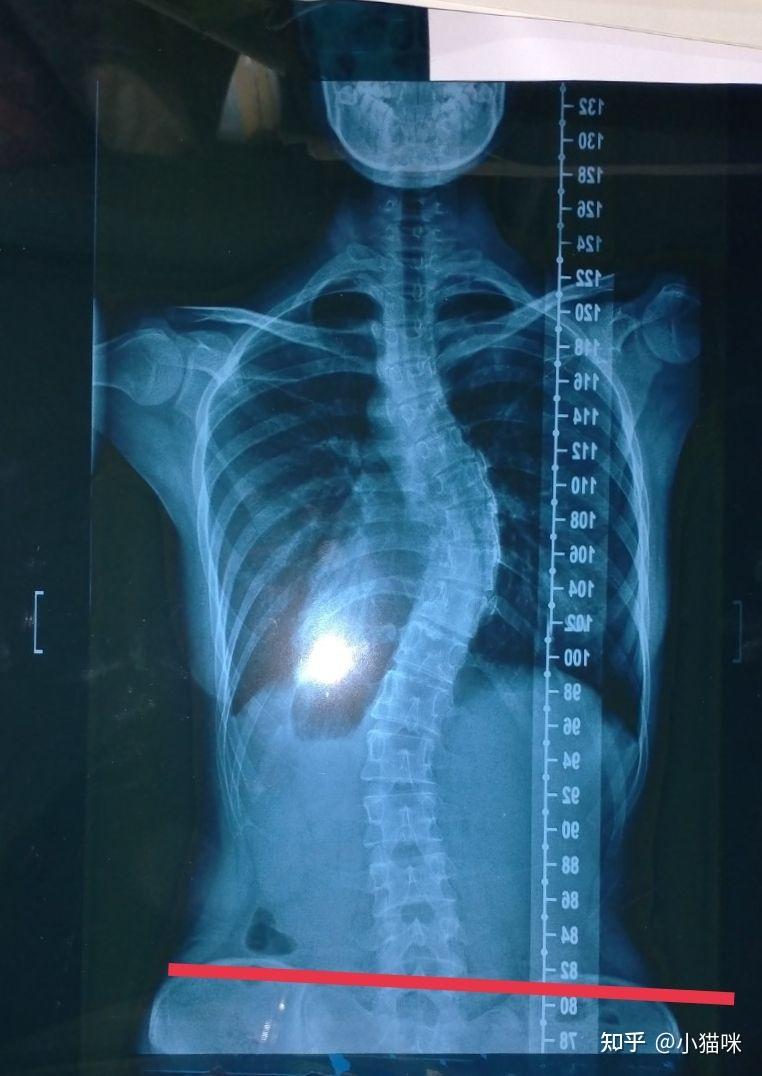 胸椎侧弯希望专业人士解答一下