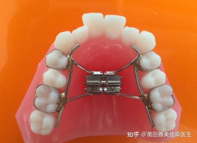 扩弓器有哪些种类