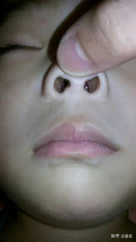 关注问题 ​ 写回答 登录/注册 鼻病毒 带状疱疹症状表现 鼻腔烂骀