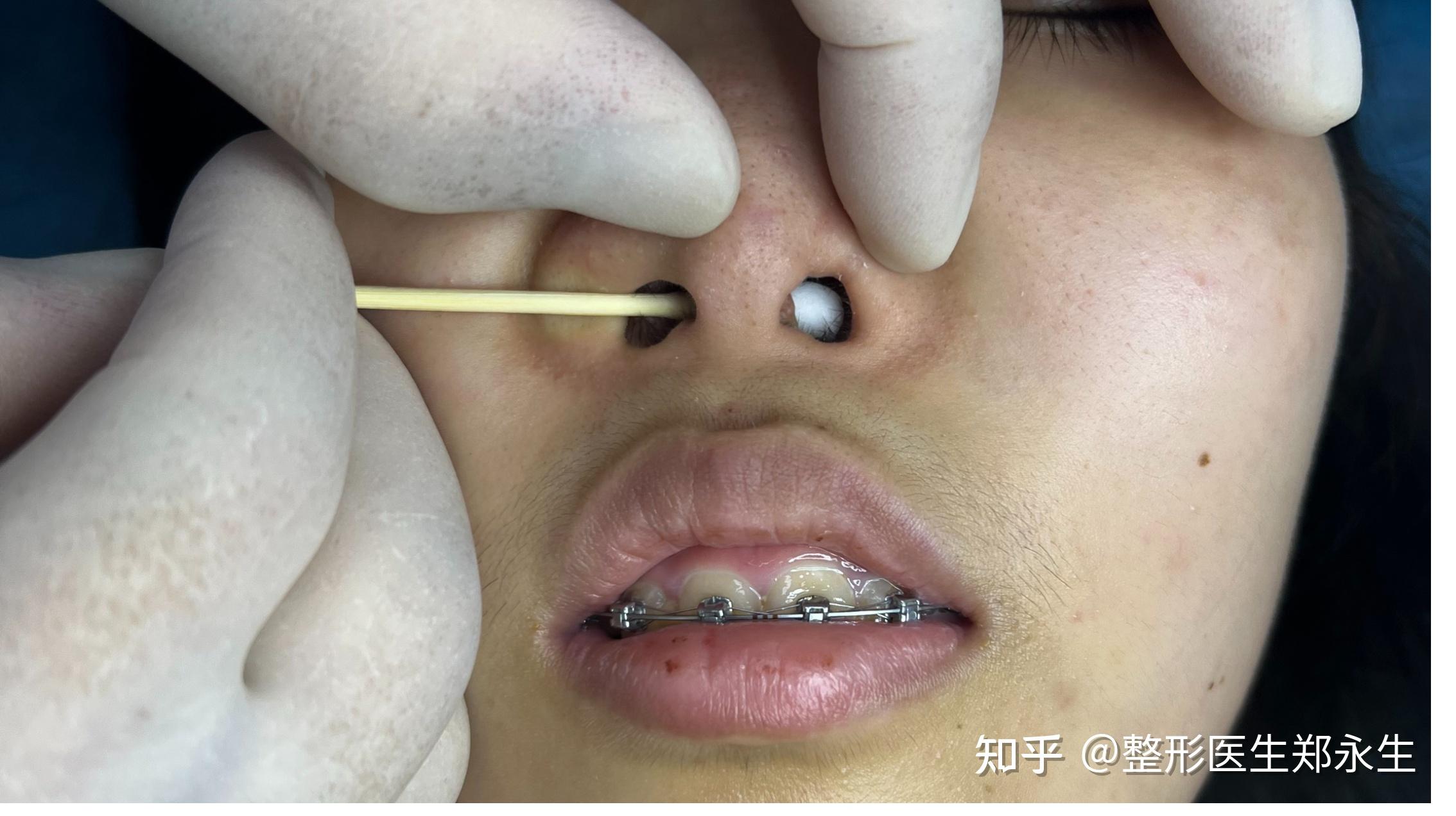 鼻中隔穿孔? - 知乎