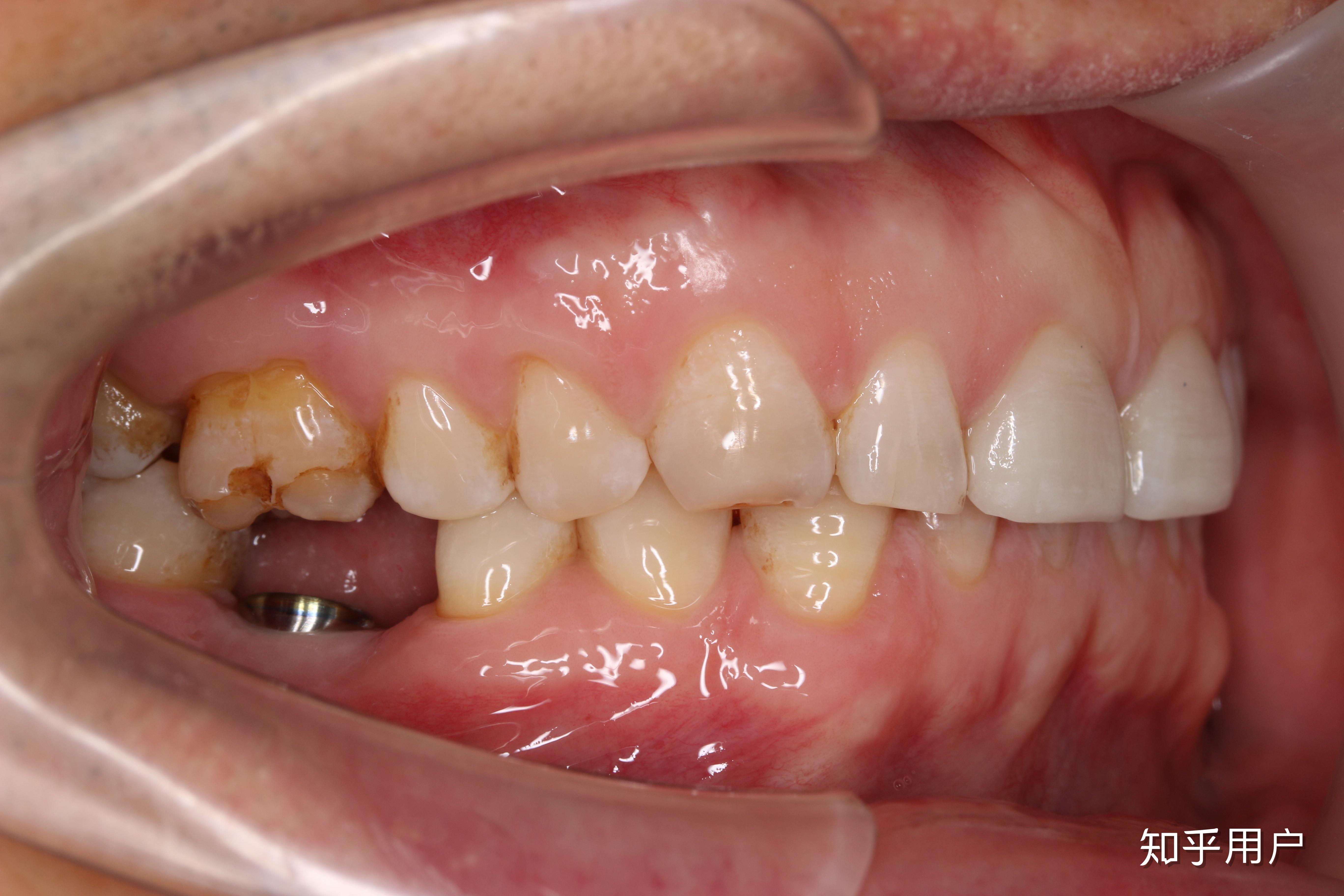 种植牙大概需要多长时间? - 知乎