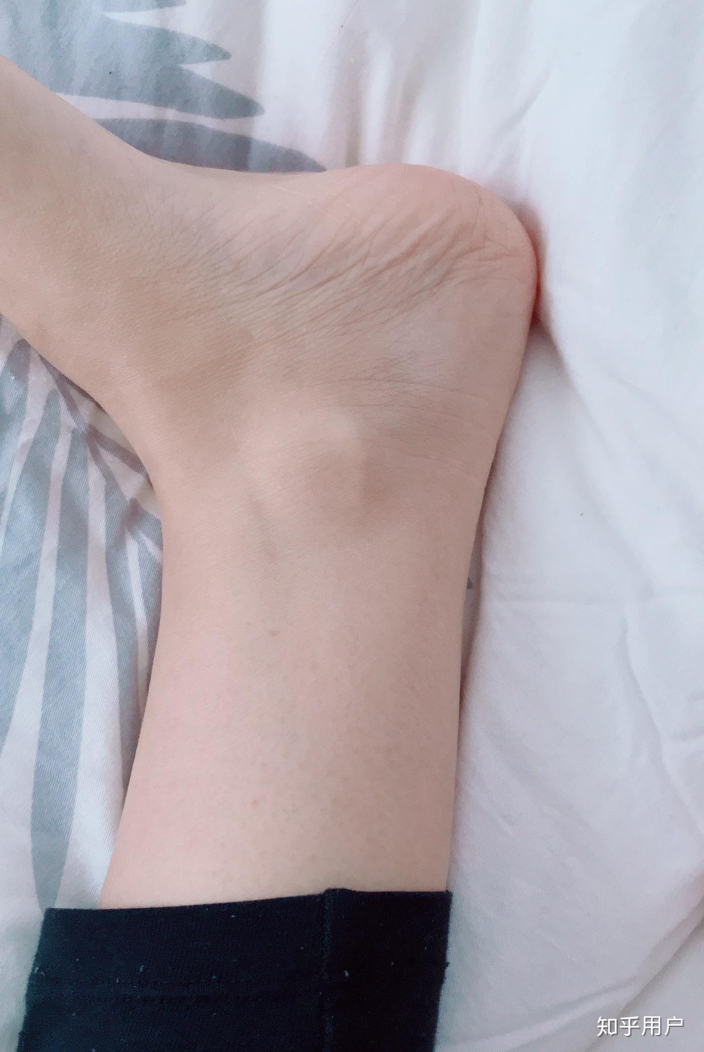 没有脚踝是怎么样一种体验?