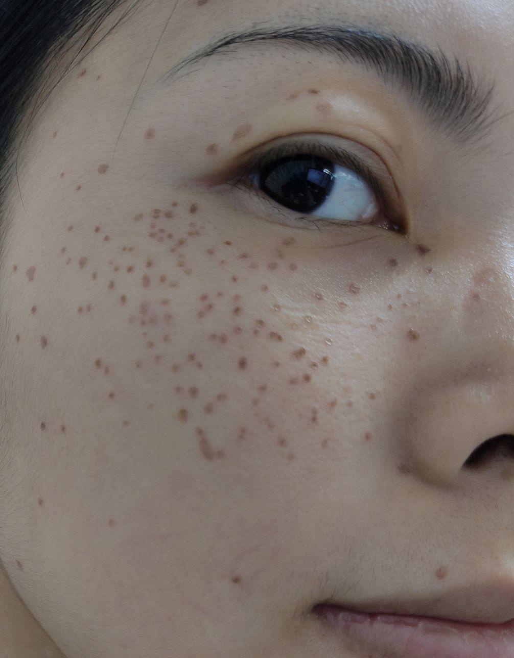 点斑后的恢复期