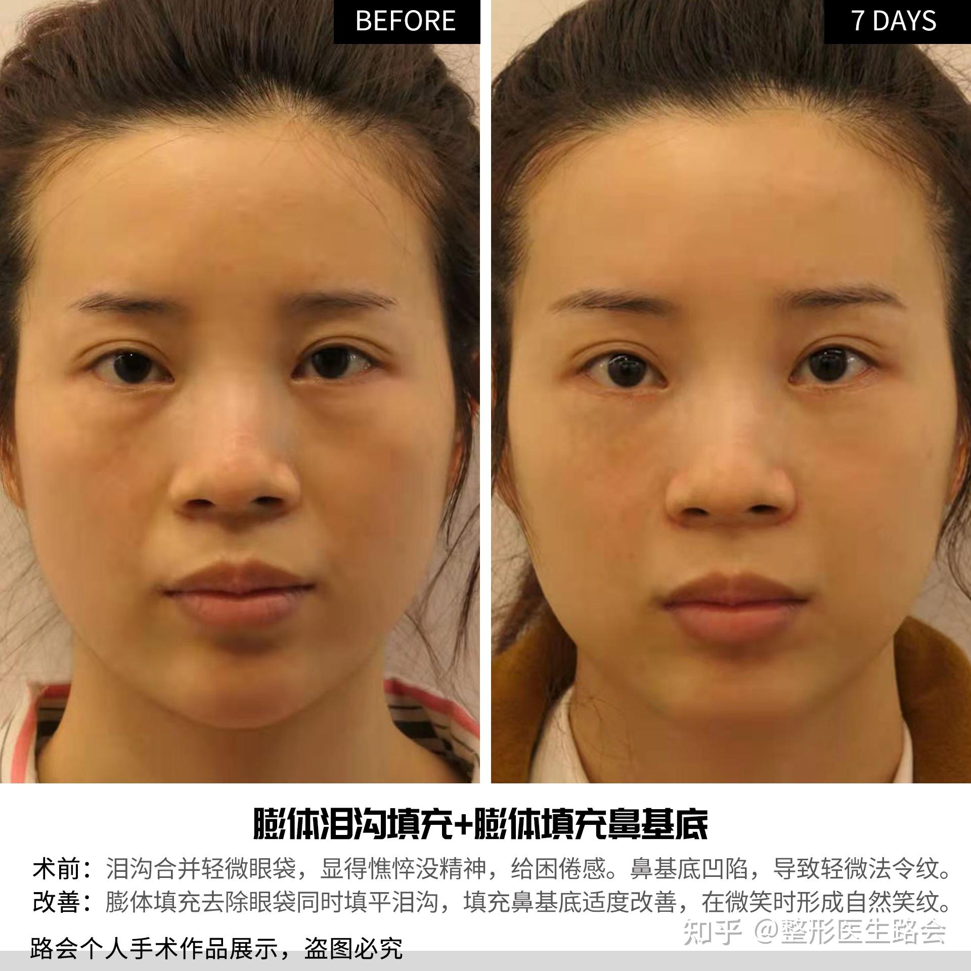 法令纹太深了,好难看啊!我才刚刚30岁,有没有快速有效的消除法令纹的办法呢? - 知乎
