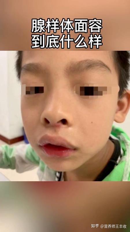 为什么会得腺样体肥大