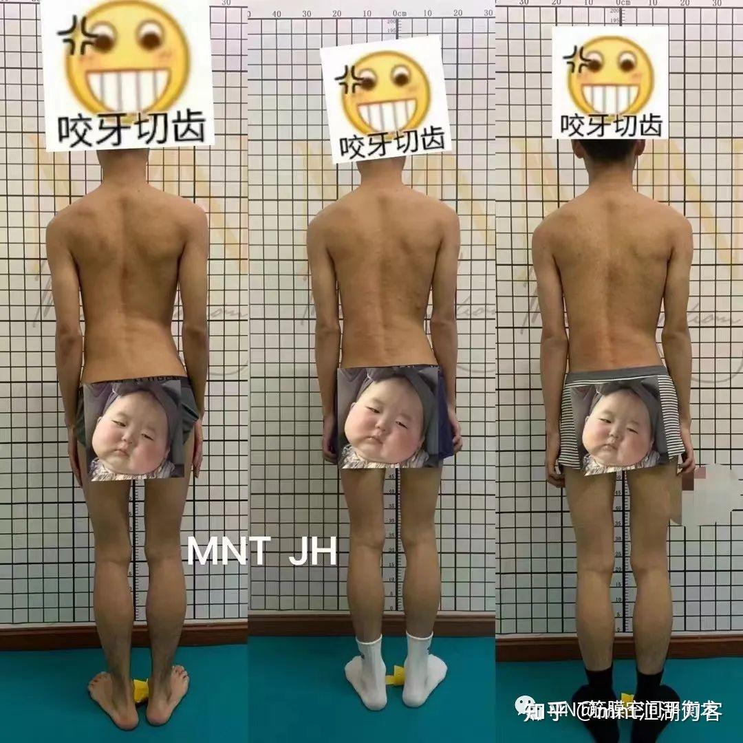 正骨可以改善长期驼背导致的弓背吗?也就是背部拱起. - 知乎